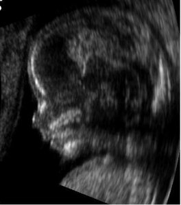 Embryo_at_14_weeks_profile